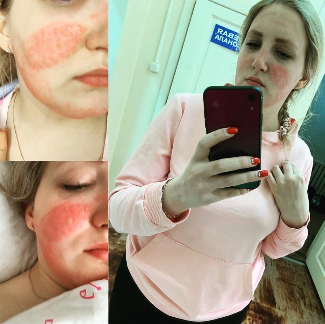 Медсестра из Александрова получила ожоги из-за костюма химзащиты